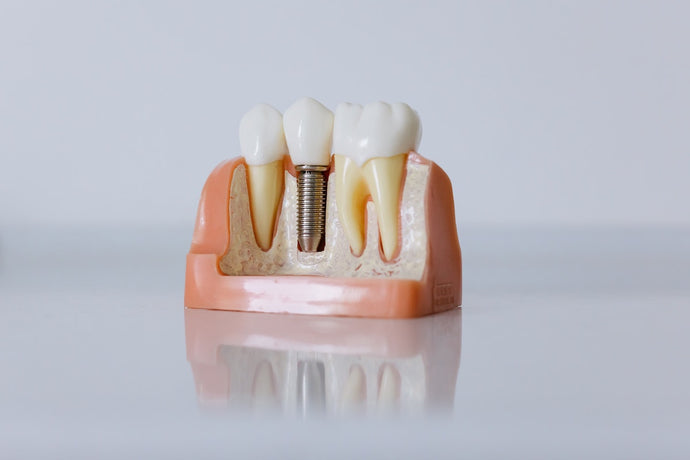 The Down Low on Dental Implants